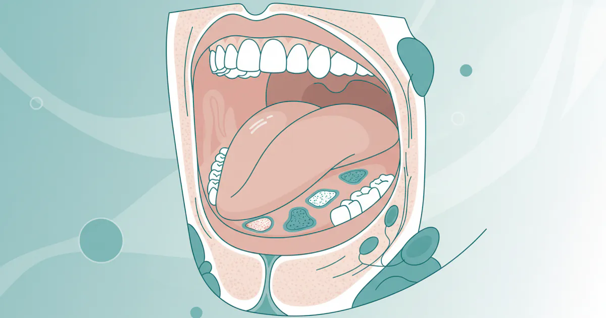 1st Oral Cancer Stages: Complete Guide