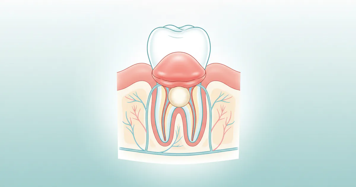 Abscess Gum: Complete Guide