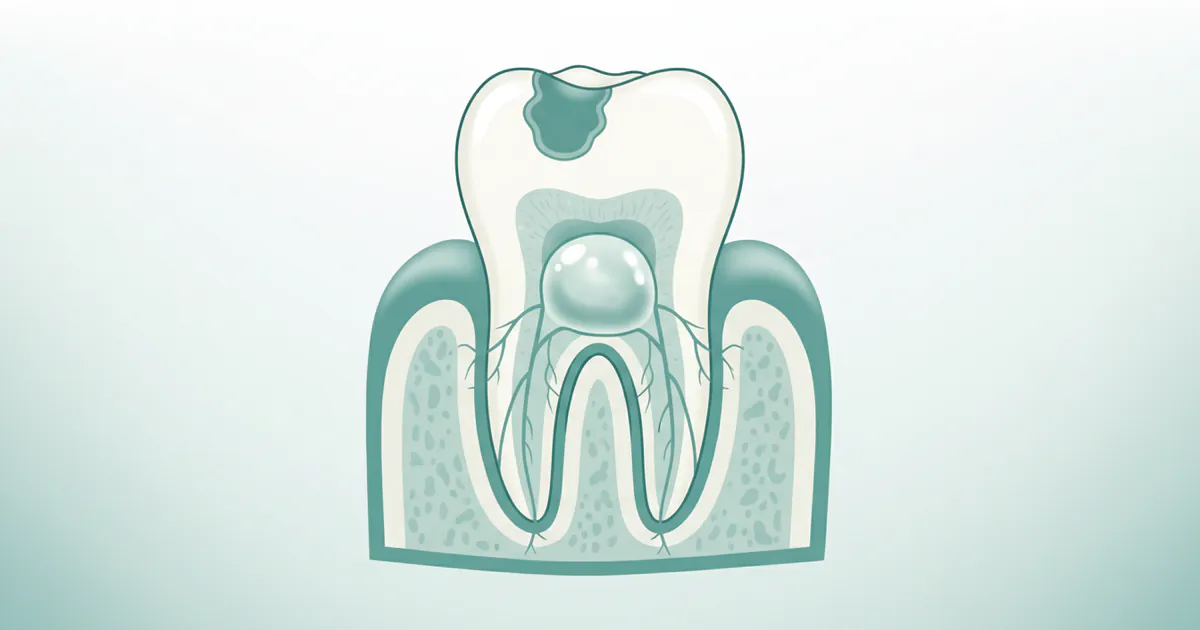 Abscessed Tooth: Complete Guide