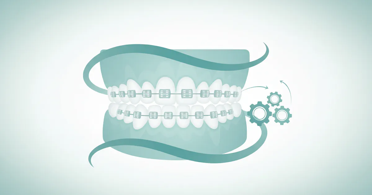 Adult Braces: Complete Guide