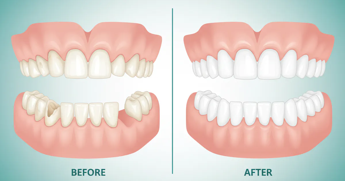 Before and After Dentures: Complete Guide