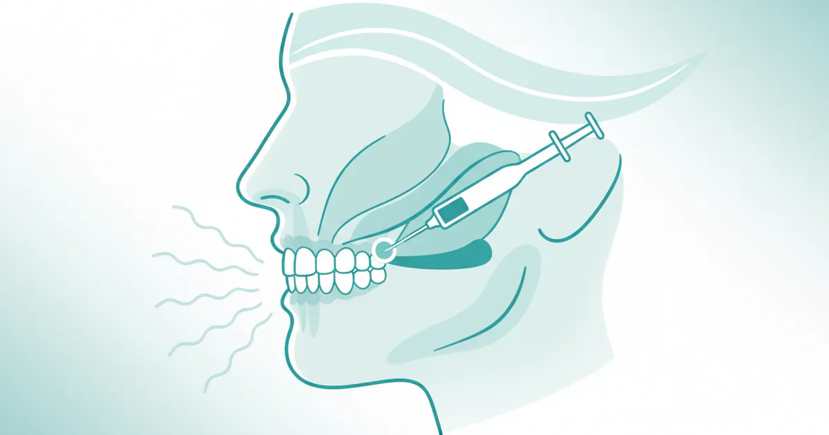 Botox for Jaw Clenching: Complete Guide