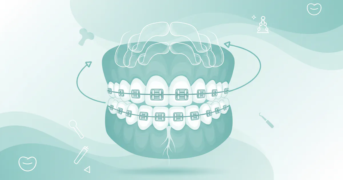 Braces Near Me: Complete Guide