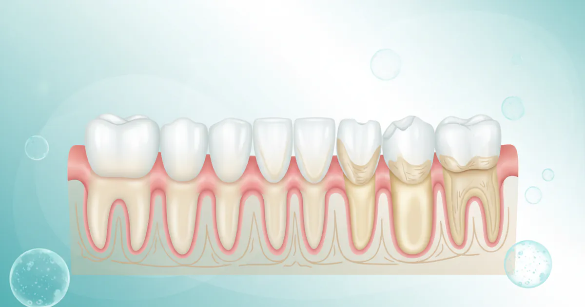 Bulimia Teeth Damage: Complete Guide