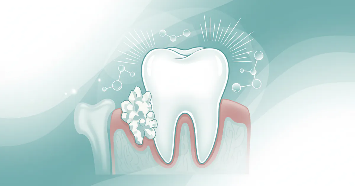 Calcium Deposit on Teeth: Complete Guide