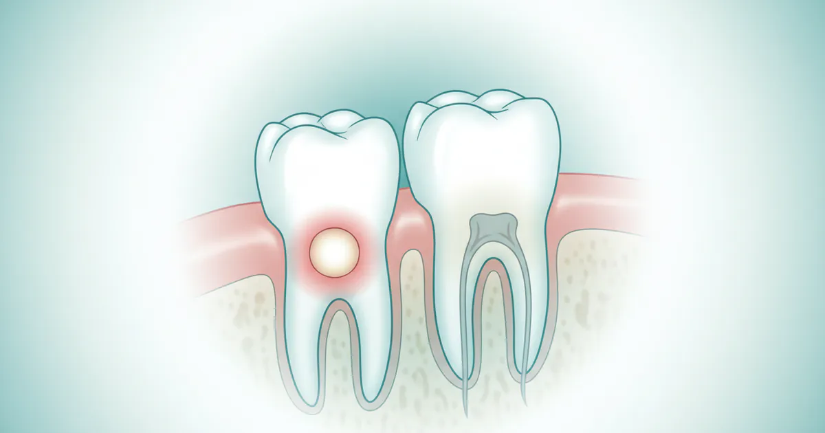 Canker Sore on Gum: Complete Guide