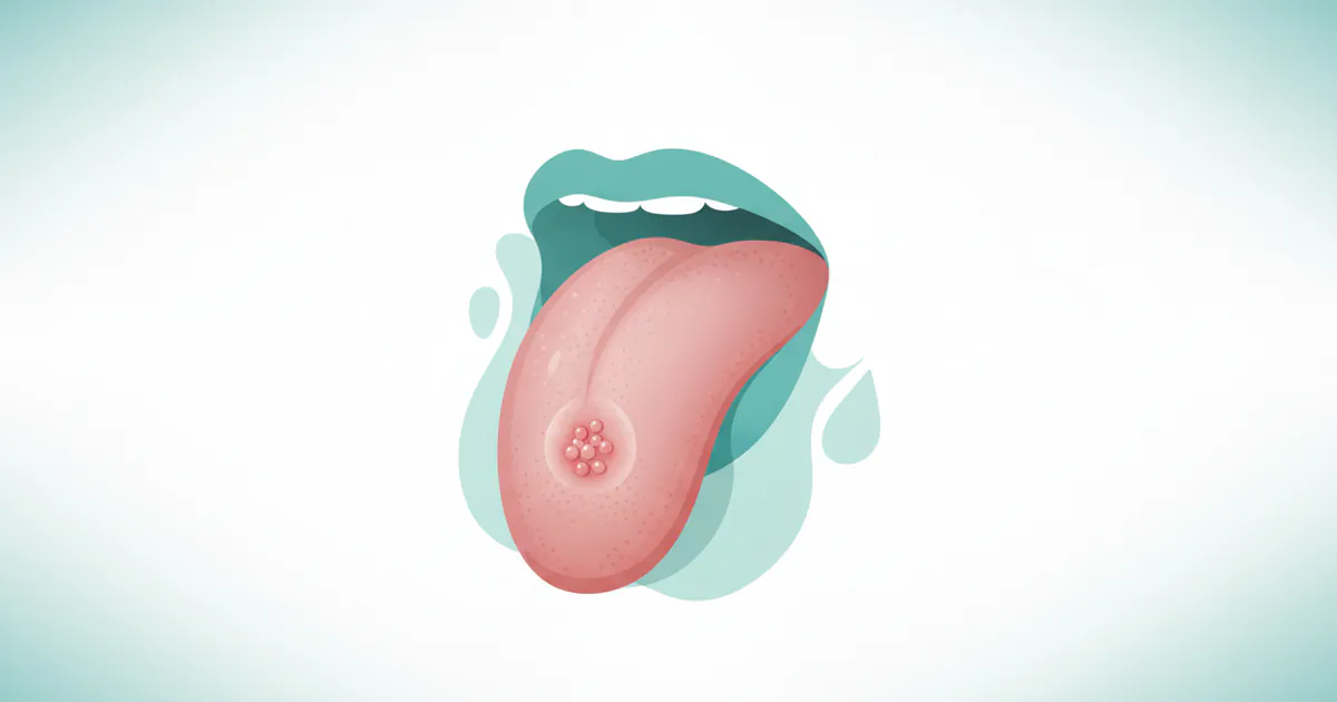 Cold Sore on Tongue: Complete Guide