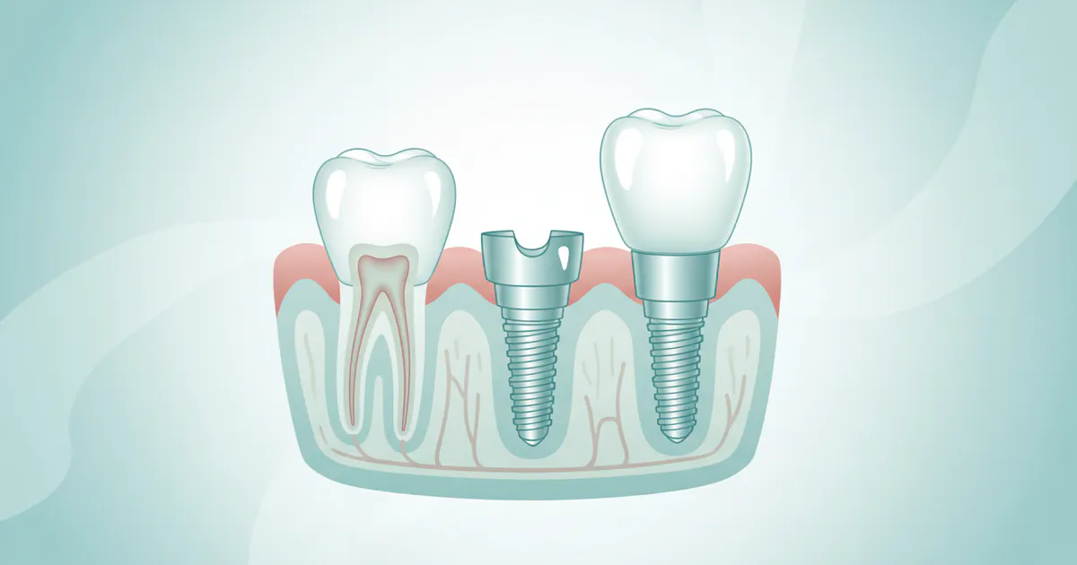 Complete Guide to Dental Implants: Everything You Need to Know