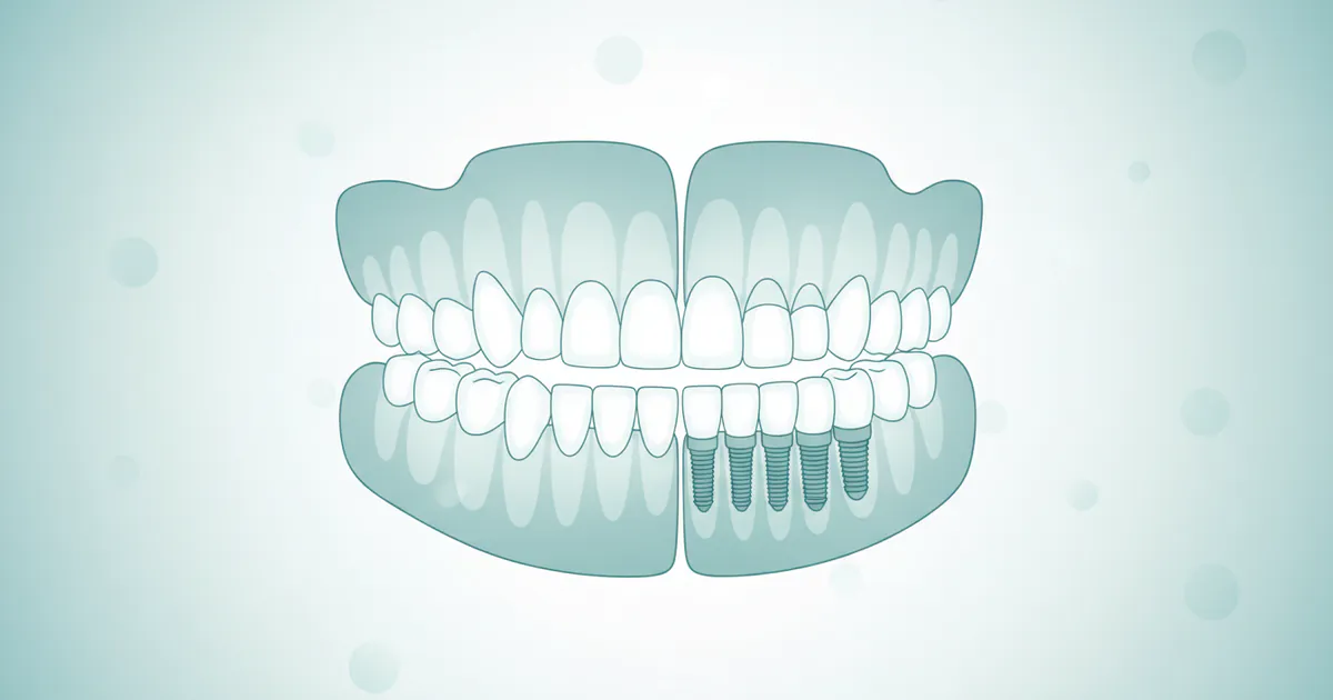 Complete Guide to Prosthodontics & Dentures: Everything You Need to Know