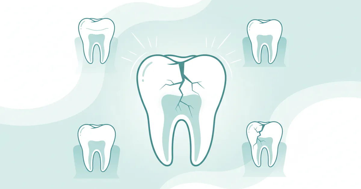 Cracked Tooth Syndrome: Complete Guide