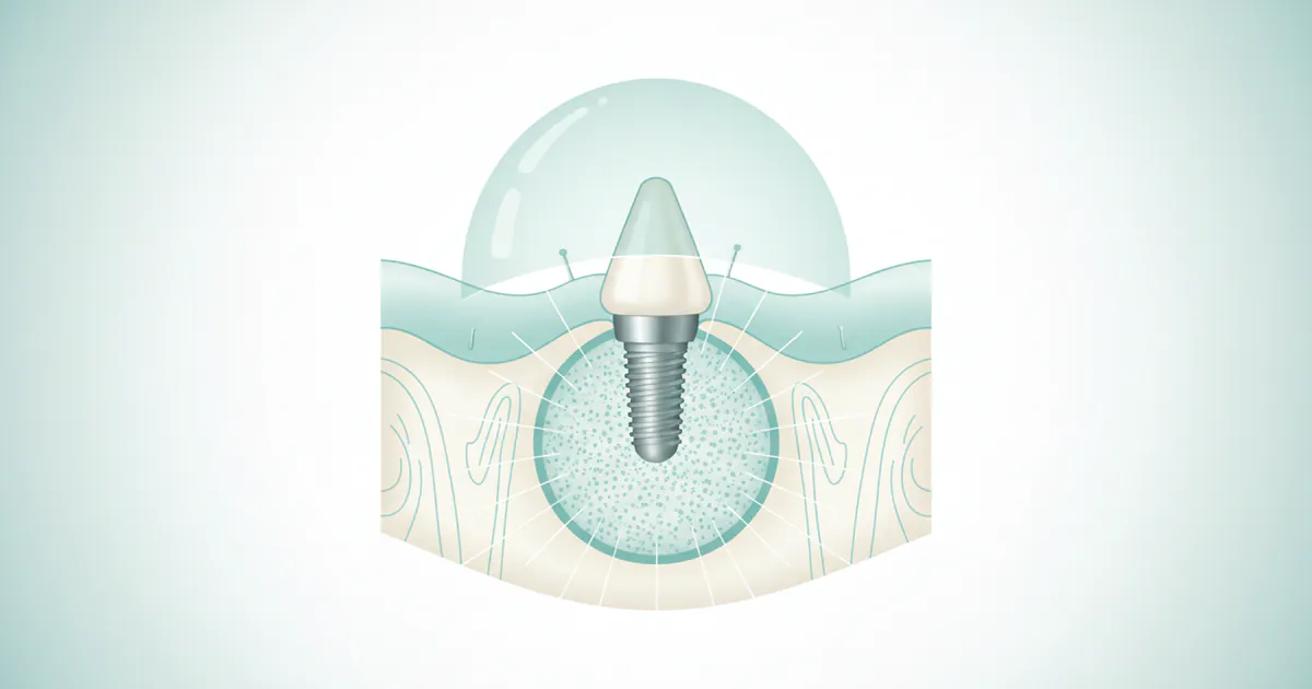Bone Graft for Implant: Complete Guide