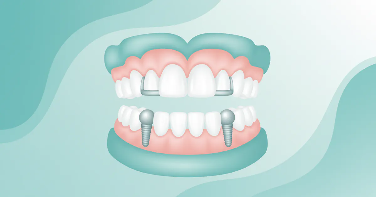Dentures Over Implants: Complete Guide