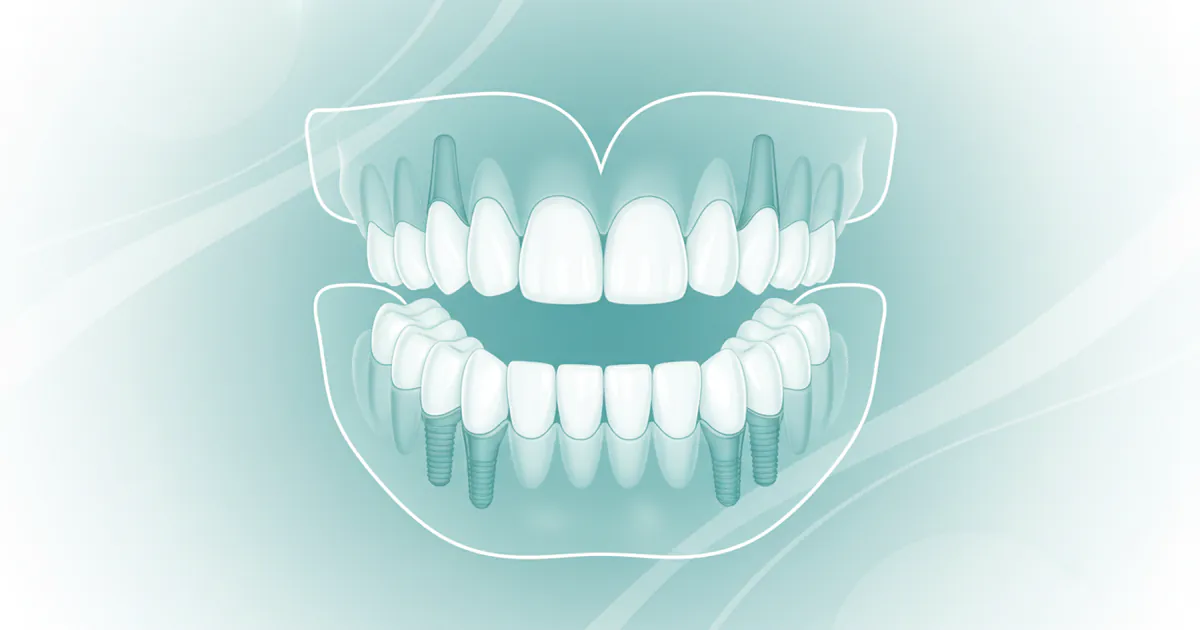 Full Mouth Denture Implants: Complete Guide