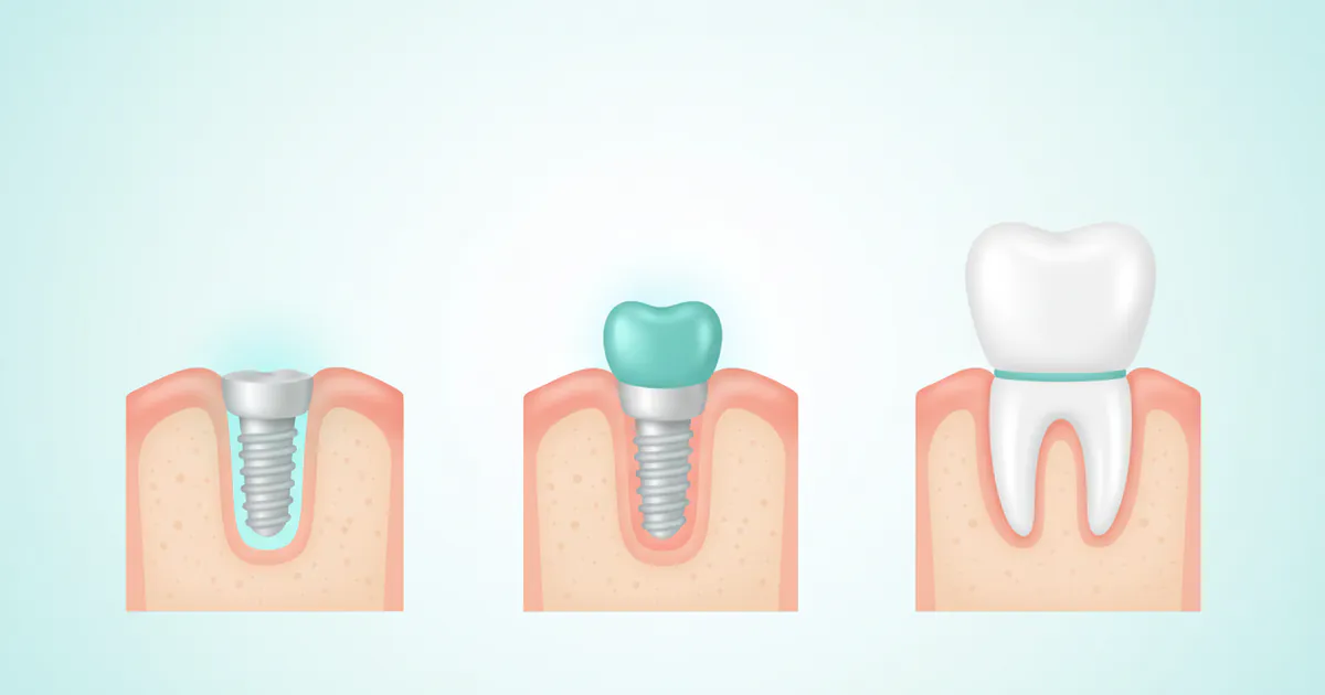 How Do Teeth Implants Work