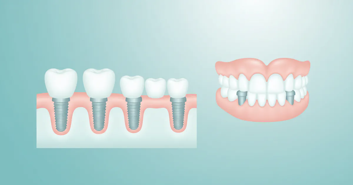 How Much Are Implants for Teeth