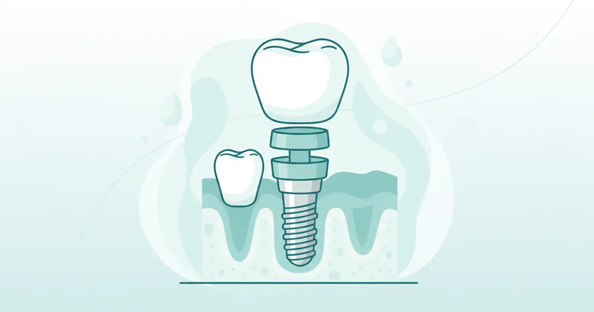 How Much Does a Molar Implant Cost