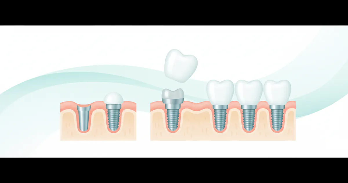 How Much Does Teeth Implants Cost