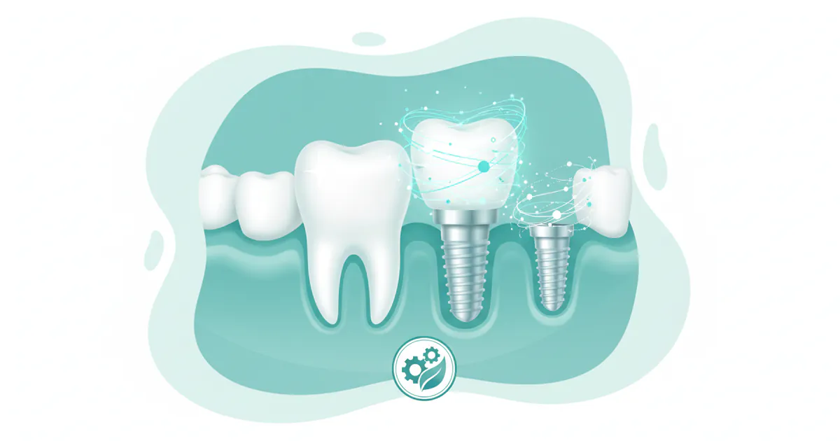 How Much Is a Tooth Implant With Insurance
