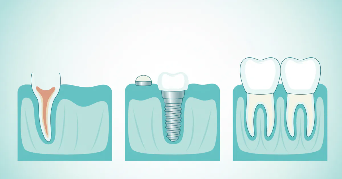 How Much Is an Implant Tooth