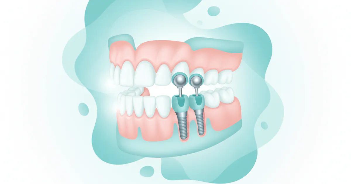 Implant-retained Dentures: Complete Guide