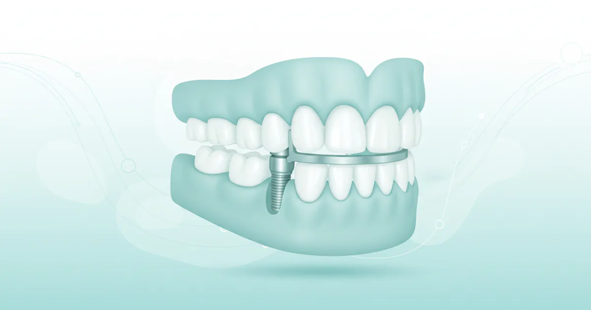 Implant Supported Dentures in Little Rock: Complete Guide