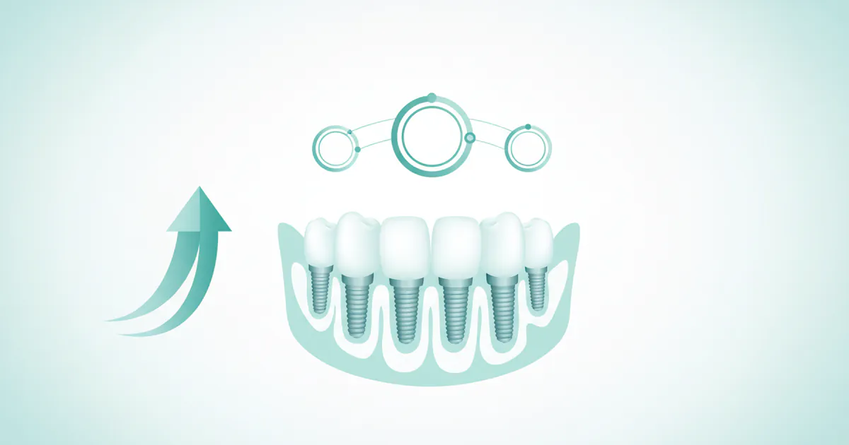 Implant Teeth Price: Complete Price Guide 2026