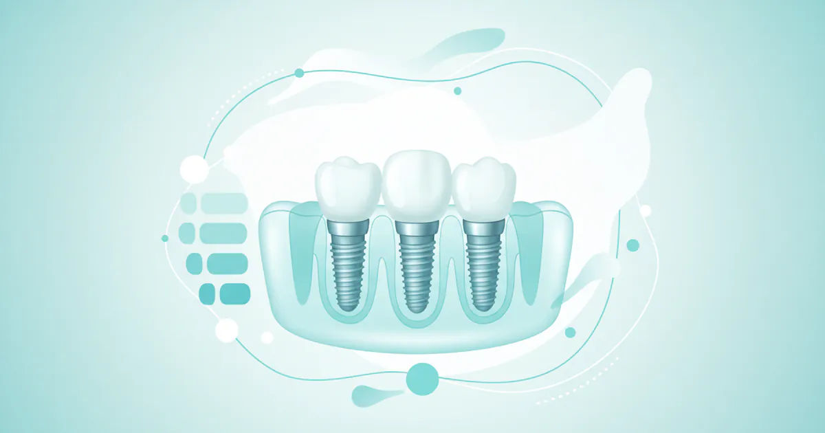 Implantes: Complete Guide