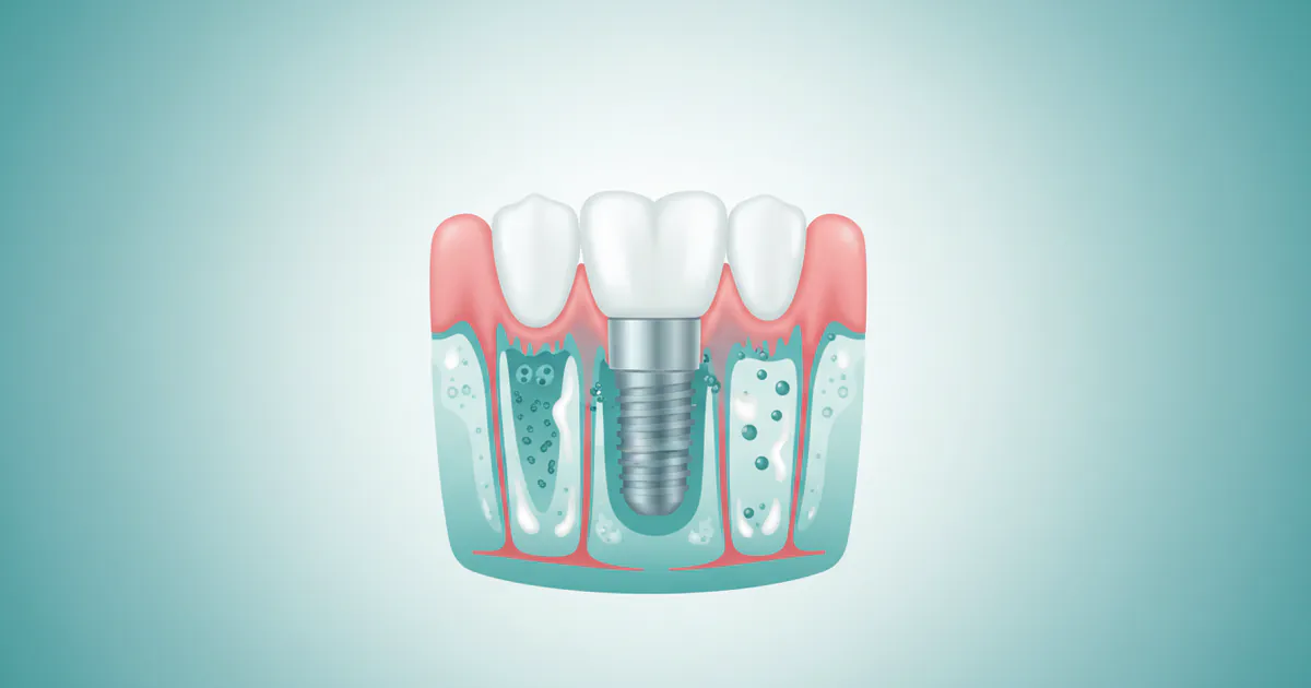Implantitis: Complete Guide