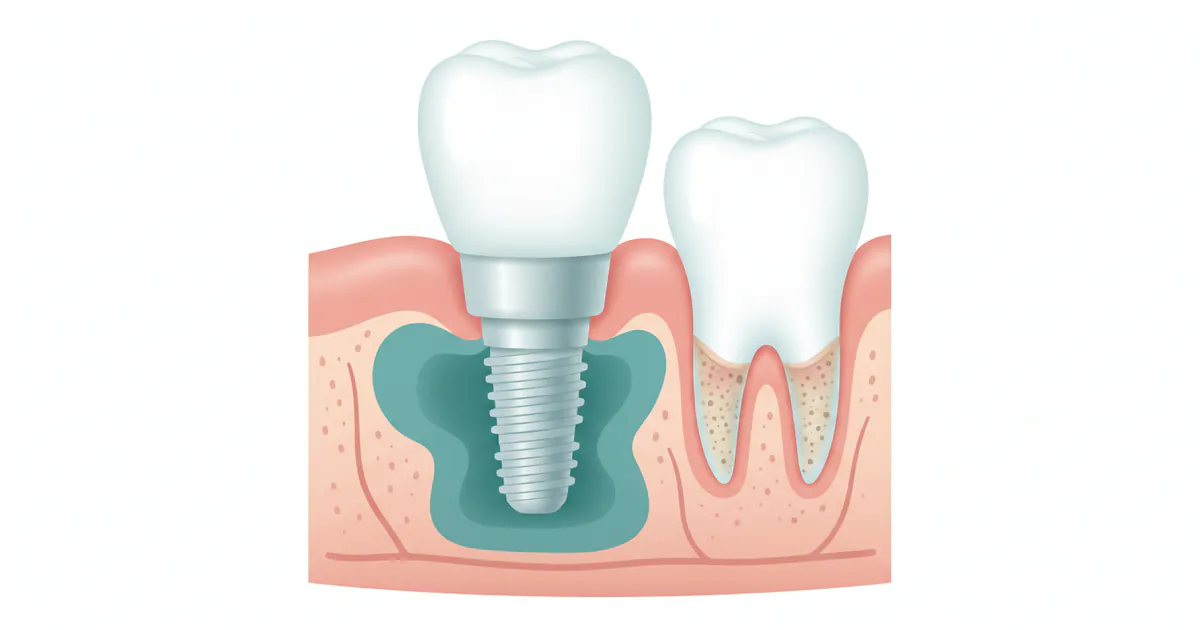 Periimplantitis: Complete Guide