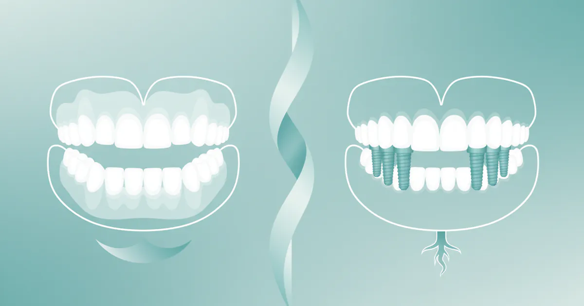 Permanent Dentures vs Implants: Complete Comparison Guide