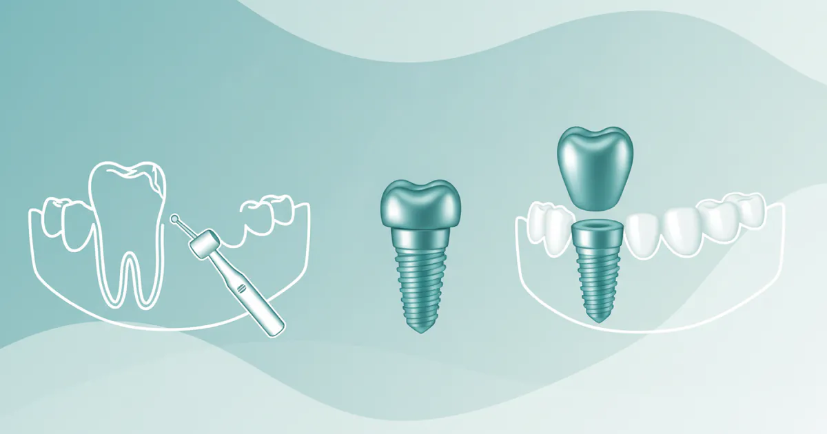 Same Day Implant: Complete Guide