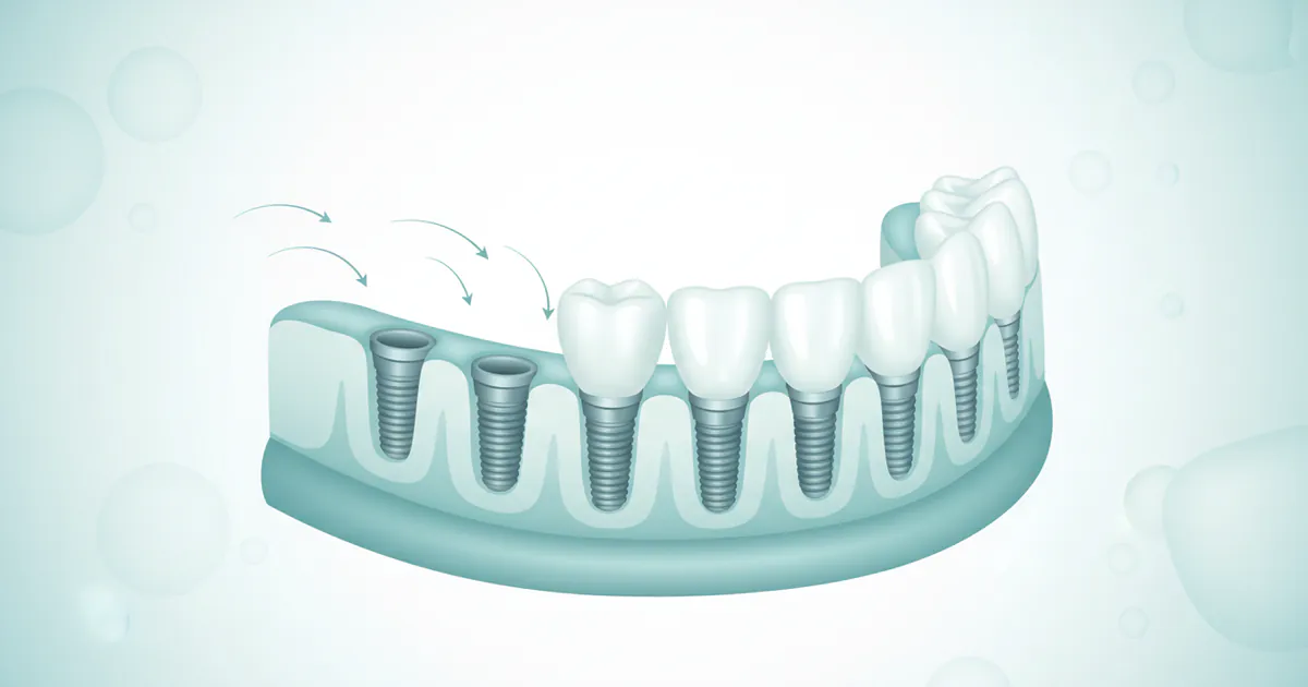 Same Day Implants: Complete Guide