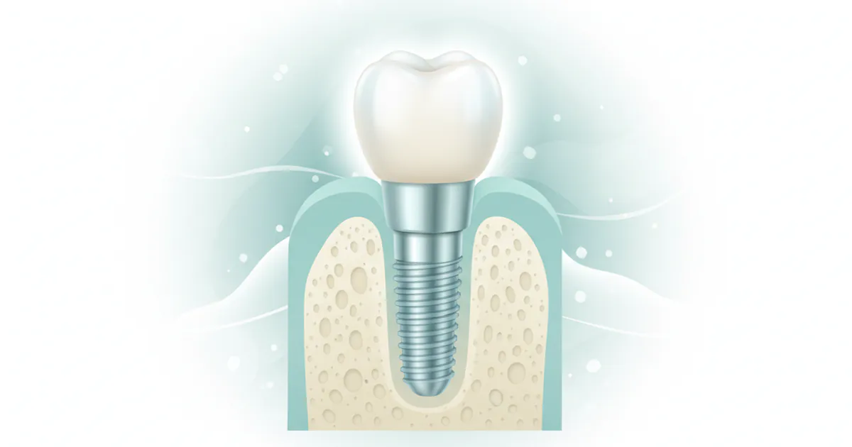 Titanium Implant: Complete Guide