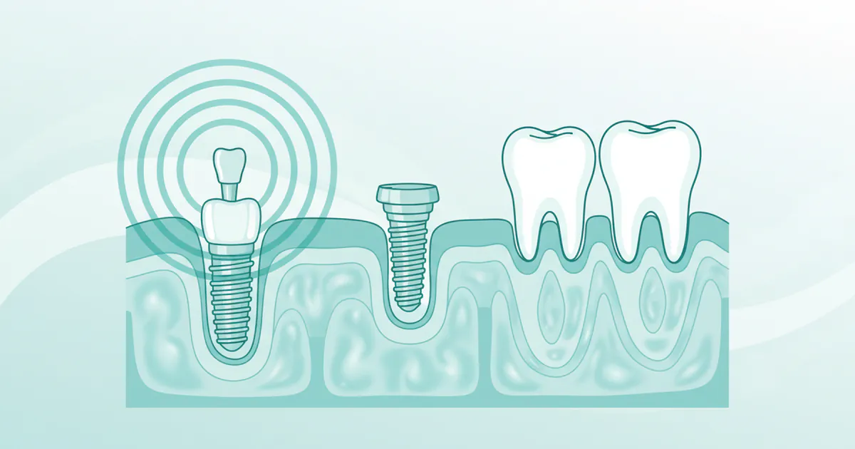 Tooth Implant Recovery: Complete Guide
