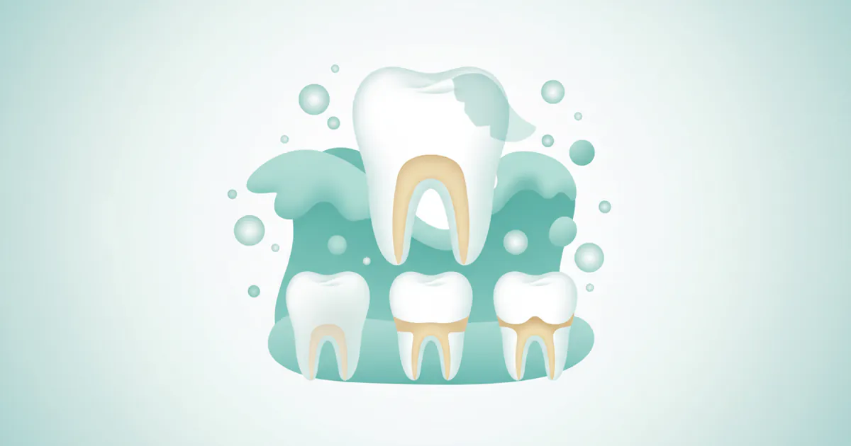 Erosion on Teeth: Complete Guide
