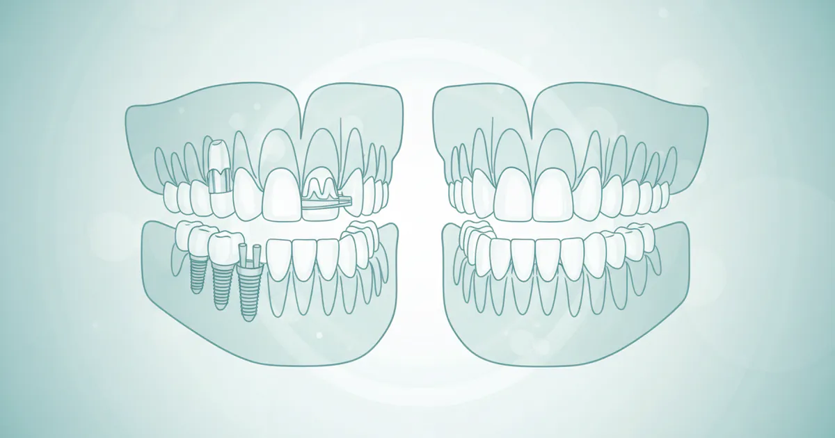 Full Mouth Reconstruction Near Me: Complete Guide
