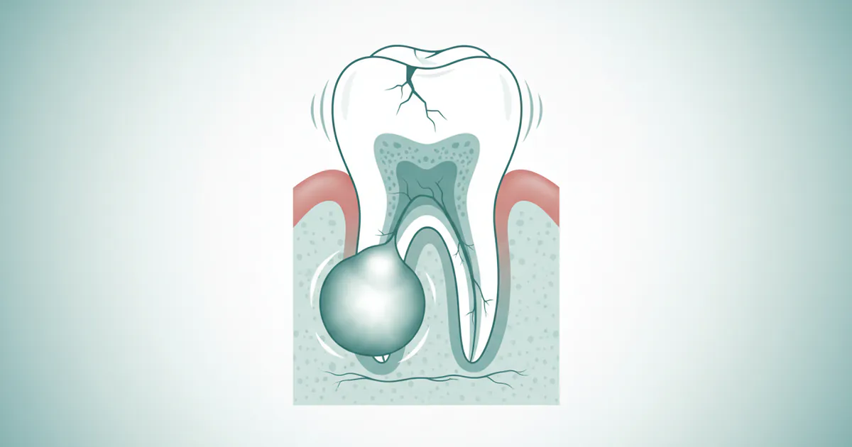 Abscess: Complete Dental Guide