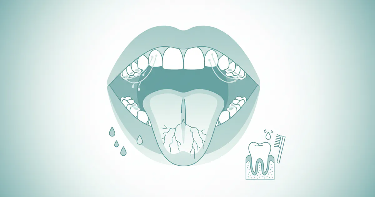 Xerostomia: Complete Dental Guide