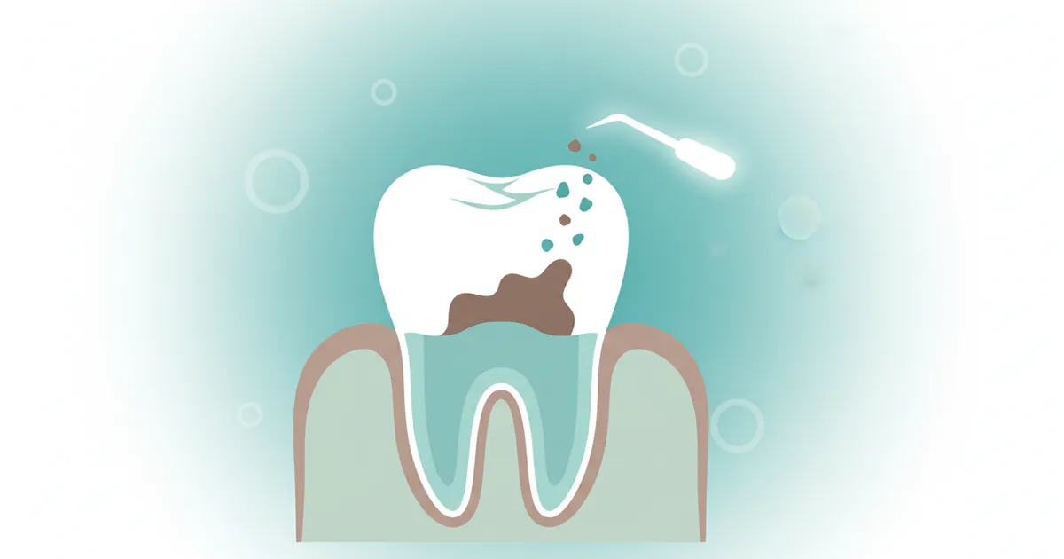 How to Remove Tooth Decay Yourself
