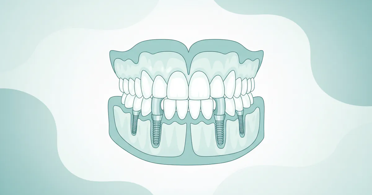 Implants With Dentures: Complete Guide
