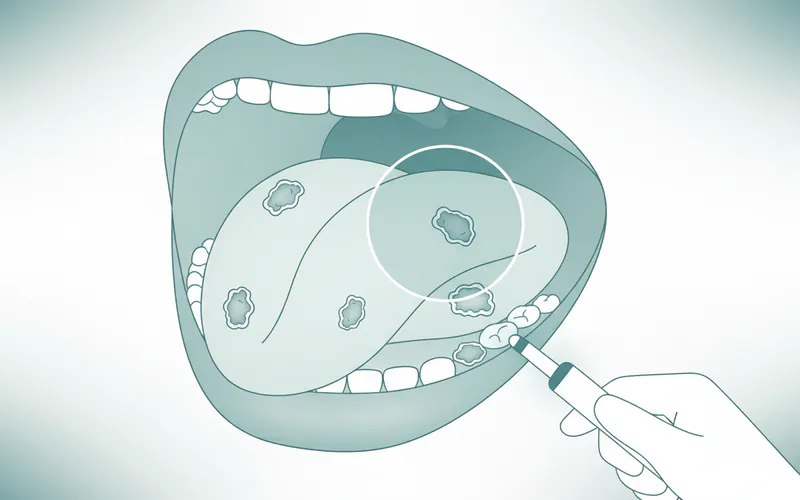 Illustration related to 1st Oral Cancer Stages: Complete Guide