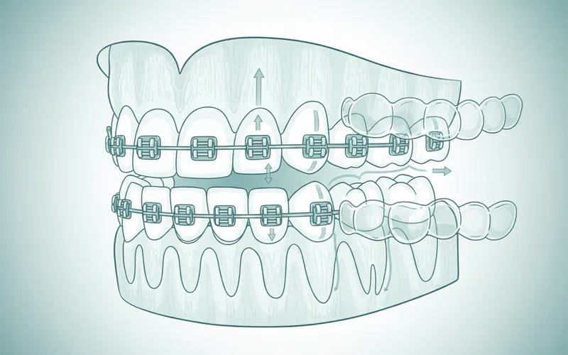 Illustration related to What It Is: Adult Orthodontics Explained