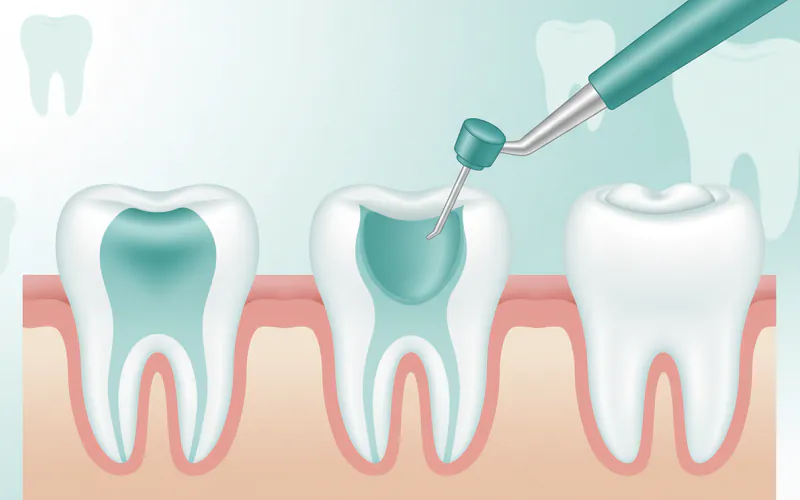 Illustration related to Treatment Options and Step-by-Step Processes (General Dental Care)