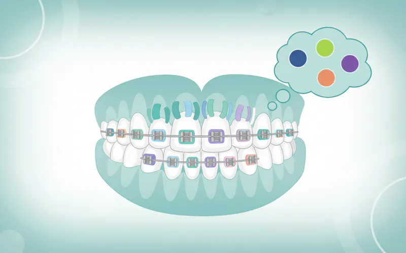 Illustration related to Best Braces Colors: Complete Guide