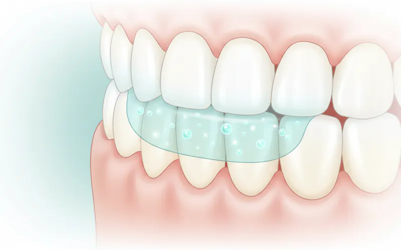 Illustration related to What Teeth Whitening Strips Are