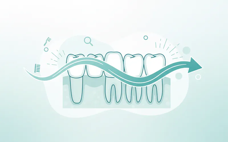 Illustration related to How long does a dental bridge last?