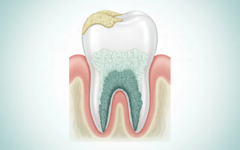 Detailed illustration showing plaque forming on a tooth surface, then hardening into calculus (tartar) both above and below the gumline. Label areas of supragingival and subgingival calculus clearly, showing how it sits on the enamel and irritates the gum.