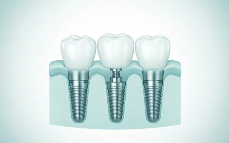 Illustration related to What are dental implants?