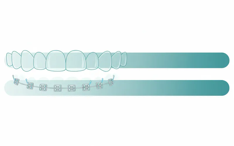 Illustration related to How long do I need to wear Invisalign or braces?
