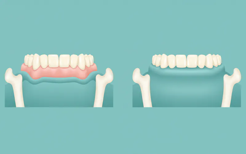 A diagram showing the cross-section of a jawbone with a denture on top. One side shows an ill-fitting denture with a gap, and the other side shows a well-fitting denture (either new or relined) with the soft tissue layer clearly visible, demonstrating the precise fit.